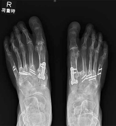 RA前足部変形後