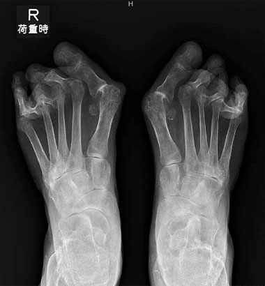 RA前足部変形術前