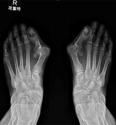 MTP関節固定術前
