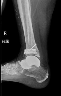 足の外科センター 当センターでの手術 / 府中恵仁会病院