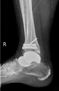 人工距骨併用人工足関節全置換術後 側面2