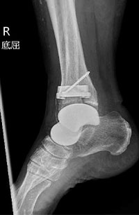 人工距骨併用人工足関節全置換術後 側面3