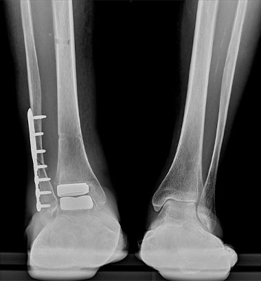 外側侵入型人工足関節全置換術後