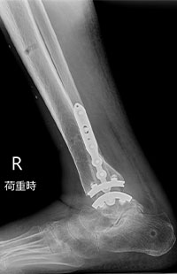 外側侵入型人工足関節全置換術後 側面1