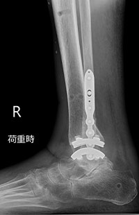 外側侵入型人工足関節全置換術後 側面2