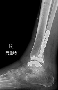 外側侵入型人工足関節全置換術後 側面3